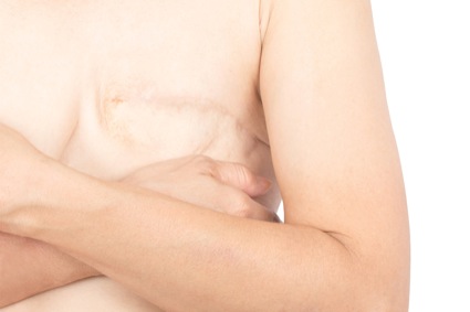After no mastectomy reconstruction reconstruction is