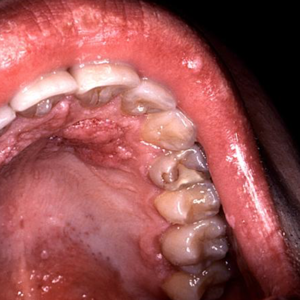 Saliva Test Detects Hidden Throat Cancer